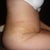 After Tummy Tuck