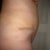 2 weeks after Tummy Tuck