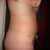 5 weeks after Tummy Tuck