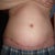 6 weeks/ 2 areas with infection but healing good