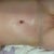 This is one week after the procedure lying down