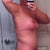 100 days post op - side view