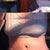 3 days post op.
