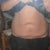 one week pre-op