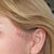 Highly visible scars and folds/pleats of skin after "mini-lift" by Professor Donald Hudson.