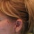 Scars and folds after "mini-lift" by Dr. Donald Hudson at Renaissance Surgical Clinic.