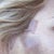 Hematoma after "mini-lift" by Dr. Donald Hudson at Renaissance Surgical Clinic.