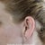 Mature wide white scars and folds/pleats of skin 12-months after "mini-lift" by Dr. Donald Hudson at Renaissance Surgical Clinic.