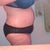 Very swollen