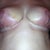 Underneath of breasts day 12 (the flash was on, it makes it look worse than it is but is easier to see some of the bruising and redness)