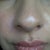 2 months after front view
