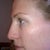 day 6-you can see how all the dark spots are gone, there are still some coffee grain spots by my hairline