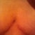 6.5 weeks, center (cleavage) scar
