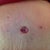 This is just minutes after my BB revision surgery. Before it got covered with bandages. Tummy very swollen.