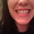 Day 1- my teeth with my first set of invisalign trays