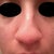 Before---You can see my crooked nose(deviated septum).