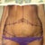 Picture Dr took in office day of surgery
Before Tummy Tuck
