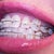 16 week right view of teeth.  Notice the wide spaces?