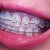 16 week right view of teeth.  Notice the wide space as the incisor is pulled away?