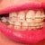 16 week left view of teeth.  Notice the wide spaces and mess this side is?  I'm embarrassed by this side.