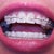 16 weeks.  It's not my imagination...all my bottom teeth are pulled to the right.  Hope they fix that:)