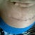 my stitches are almost fully dissolved i had few more but theyre dissapearing..my doc had to extend my incision to avoid doggy ears..im lovin it though!!
