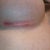 Right incision right after tapes being removed 11 days post op.