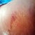 POD11 butt bruise from Lipo eventhough my flanks got Lipo'd...weird