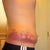 7 Days post op, side. Rainbow bruising!