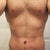 5 Weeks post-op, you can still see how loose the skin is.