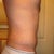 5 weeks, from the side you can see very significant results to the shape