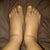 Swollen feet and ankles at the end of the day