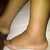 Swollen ankles