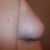 right 10 days post op
