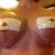 2nd bandage change