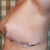 Post op day 1 left side
