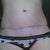 2 mo. PO scars. Tube scar is shrinking significantly, incision scar still pink but even.