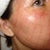 3days post smartxide