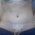 3DPO.  My hips look a little crooked to me.  not sure if it is my scoliosis, or if one side is just more swollen than the other.  The incision does go further around my left hip than it does my right.  I will keep an eye on it, just in case.  Either way, there is NOTHING i would do to fix it.  This recovery is far too painful.  So whatever I end up with is what I get...