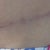 my scar as of 4 mo. PO. Line is starting to turn white