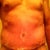 Post op Day 5, drains removed. Crusty appearance is actually fresh Neosporin cream. I didn't realize i had some swelling until I really looked at these pictures. oh well, part of the process.