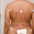 3 Days Post Op Back View
