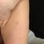 One year later, and there are ten of these liposuction scars on my legs. They are perfectly symmetrical on each side, so it's very obvious what they are. No bikinis for me this summer.