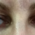The morning of the procedure (droopiness is worse in the evening)