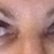 1 hour after procedure. Swelling on lids only.