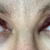 Day After procedure (Day 2) Eyes Open