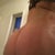 7 days post op booty shot look at the fat under bra area
