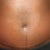 11 weeks post-op