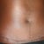 11 weeks post-op