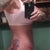 Rt side view 4 wk.  still have swelling